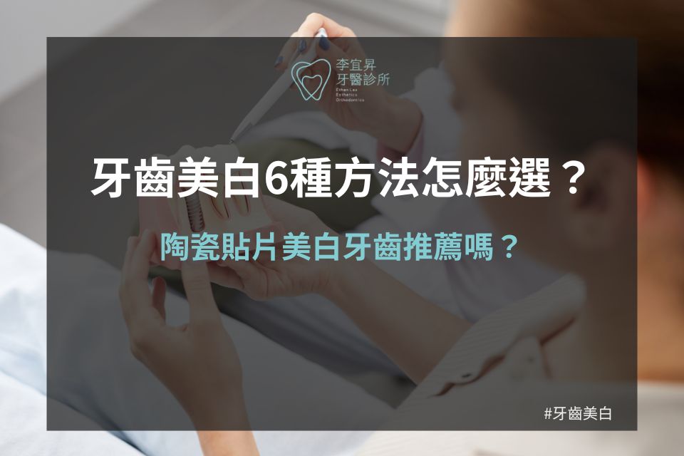 Read more about the article 6種牙齒美白方法怎麼選？陶瓷貼片美白牙齒推薦嗎？